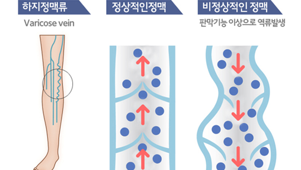 하지정맥류